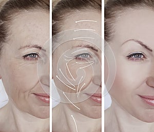 woman face wrinkles correction removal before and after procedures, arrow