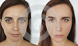 Woman face wrinkles correction   before and after treatment collage