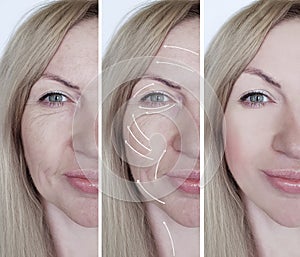 woman face wrinkles cosmetology treatment dermatology beautician removal before and after procedures, arrow