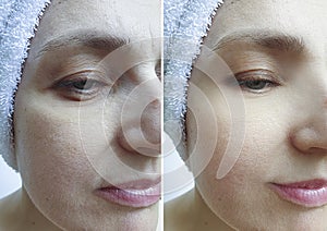 Woman face wrinkles after difference effect therapy cosmetology plastic sagging collage problem result correction treatment