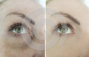 Woman face wrinkles before and after difference problem treatment