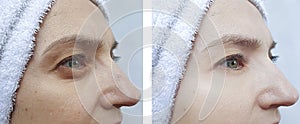 Woman face wrinkles difference before and after tension correction