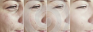 Woman face wrinkles before and after difference therapy treatment collage