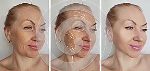 Woman face wrinkles before after hydrating therapy hydrating treatment biorevitalization correction procedures, tension