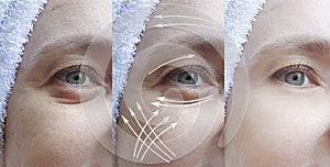 Woman face wrinkles before after lifting sagging treatment tightening arrow