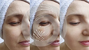 Woman face wrinkles before after lifting therapy correction sagging treatment tightening arrow