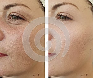 Woman face wrinkles before and after lifting treatment result removal correction collage