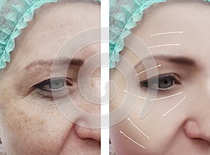 Woman face wrinkles before and after patient rejuvenation therapy difference procedures, arrow