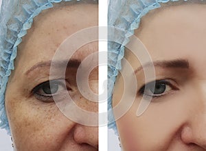 Woman face wrinkles pigmentation removal treatment health before and after procedures