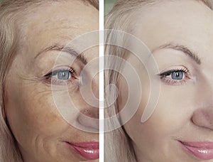woman face wrinkles before and after procedures correction