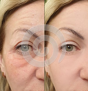 Woman face wrinkles puffiness correction effect before and after lifting treatment collage photo