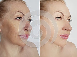 Woman face wrinkles before and after regeneration lifting difference collage treatment