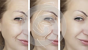 Woman face wrinkles removal dermatology medicine before and after difference treatment procedures, arrow