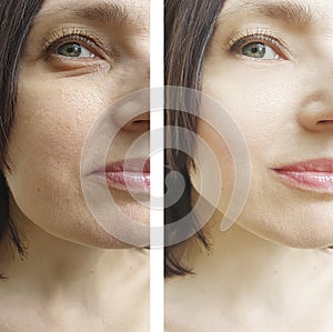 Woman face wrinkles removal lift correction rejuvenation before and after correction