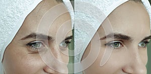 Woman face wrinkles removal before after treatment collage