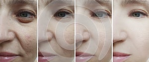 Woman face wrinkles before and after result dermatology   difference therapy treatment collage