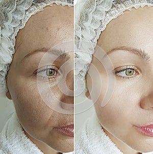 Woman face wrinkles before and after sagging contrast treatment rejuvenation cosmetology