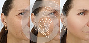 Woman face wrinkles sagging   result  removal   therapy before after treatment concept