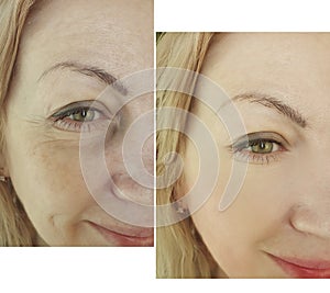 Woman face wrinkles tension before and after difference  facelift collage procedure treatment