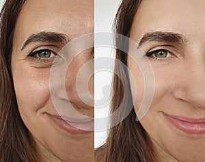 Woman face wrinkles therapy regeneration   before and after treatment collage beautician lifting
