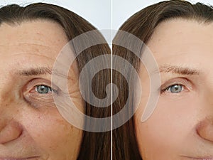 Woman face wrinkles therapy  removal  before and after sagging  treatment