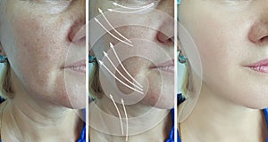 Woman face wrinkles before after thread procedure lifting treatment collage arrow