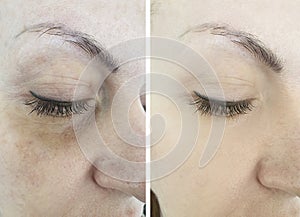 Woman face wrinkles before and after tightening  difference treatment, thread lifting