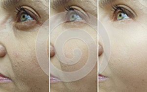 Woman face wrinkles before and after treatment, blepharoplasty