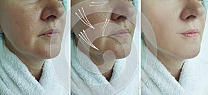 Woman face wrinkles before  after treatment collage arrow