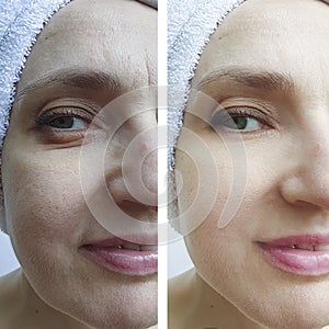 Woman face wrinkles before and after treatment difference