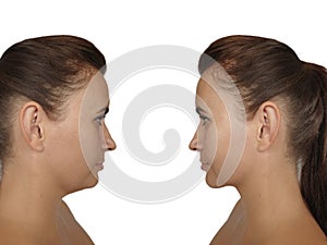 Woman face wrinkles before and after treatment, double chin