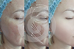 Woman face wrinkles aging revitalization difference therapy before and after regeneration removal hydrating treatment