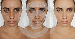 Woman face wrinkles before and after treatment sagging   collage