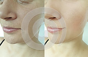 Woman face wrinkles antiaging saggy rejuvenation medicine lifting before and after treatment photo