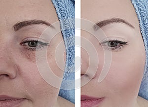 Woman face wrinkles before  after rejuvenation  beautician therapy results collage  effect photo
