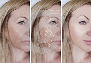 Woman facial wrinkles correction beautician results lifting difference before and after procedures arrow