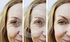 Woman facial wrinkles correction contrast before and after procedures arrow