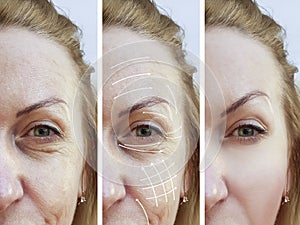 Woman facial wrinkles correction contrast before and after procedures removal