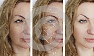 Woman facial wrinkles correction cosmetology aging before and after procedures arrow