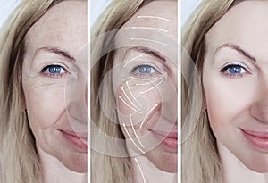 Woman facial wrinkles correction difference before and after procedures arrow