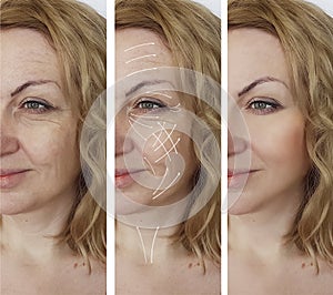 Woman facial wrinkles correction effect cosmetology aging before and after procedures arrow