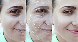 Woman facial wrinkles correction before and after procedures arrow cosmetology