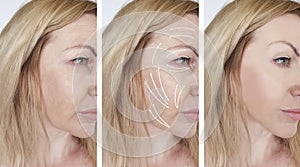 Woman facial wrinkles correction results difference before and after procedures arrow
