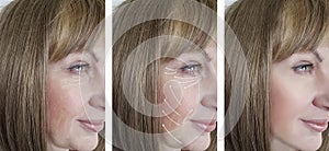 Woman facial wrinkles correction treatment therapy before and after procedures arrow