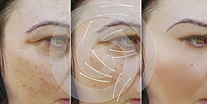 Woman facial wrinkles results before and after procedures removaltreatment