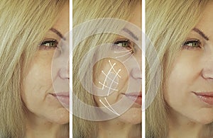 Woman facial wrinkles results treatment therapy before and after procedures arrow