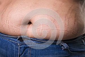 Woman with fat abdomen in blue jeans, overweight female stomach, stretch marks on belly closeup