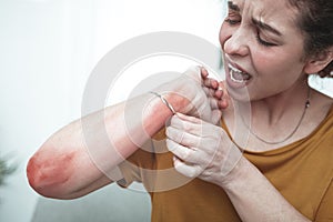 Woman feeling awful mentioning rash and reddening on her arm