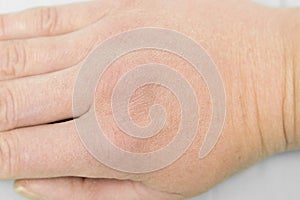 woman female person hand with dry,weathered unmoisturized skin. Banner mock up template design. Medicine,dermatology,natural