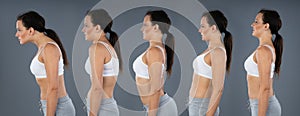 Woman With Lordosis, Kyphosis, Sway Back And Normal Curvature